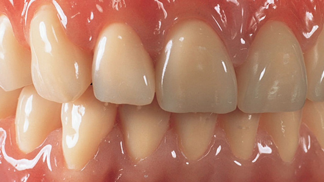 3 Step Shading Process For Beautiful Teeth