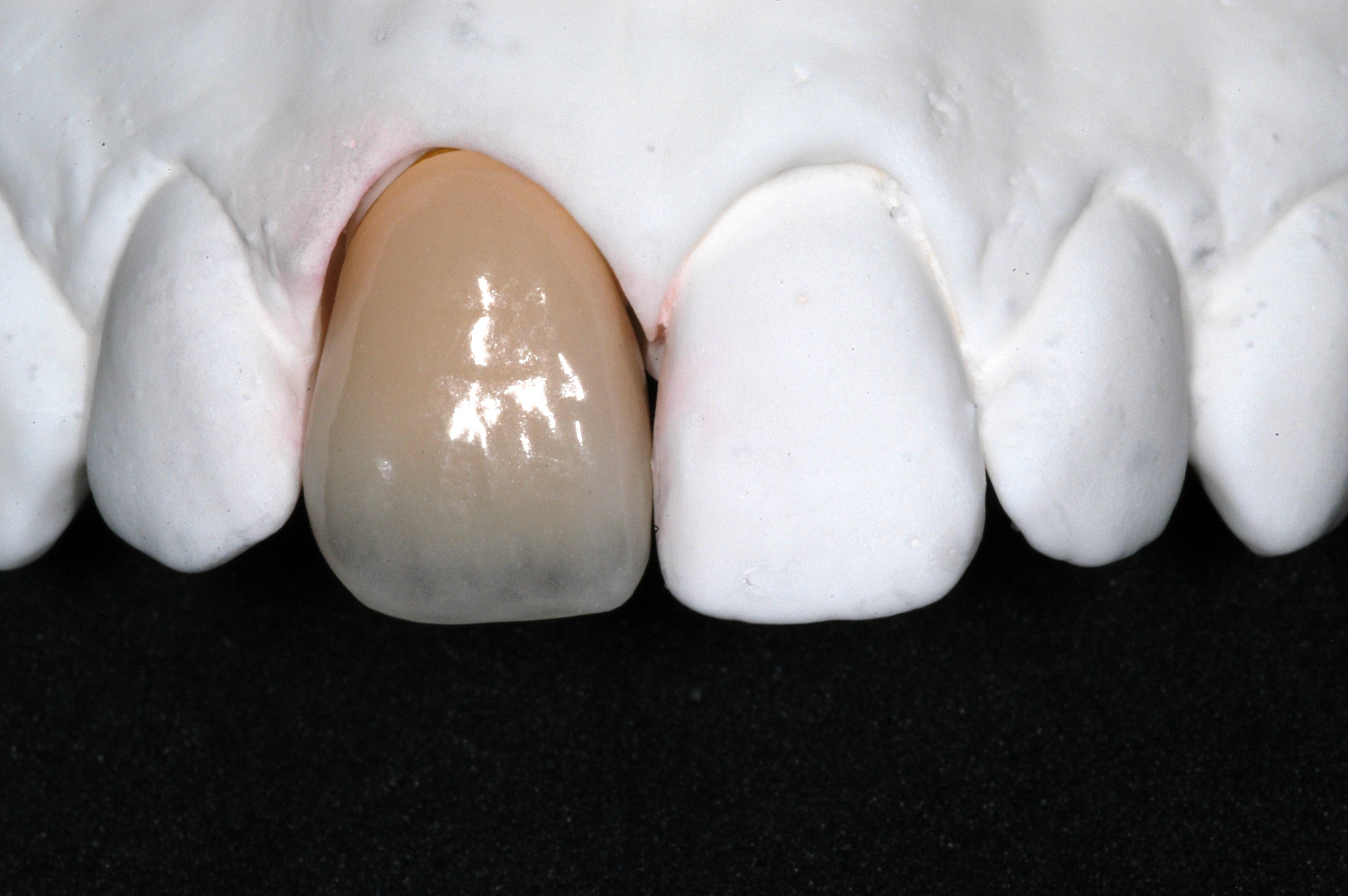 Understanding CrystalCeram® Porcelain System