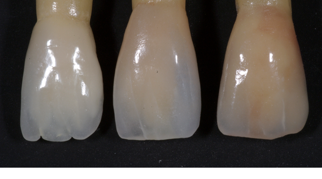 The Art and Science of PFM porcelain