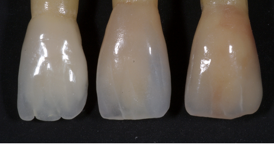 The Art and Science of PFM porcelain