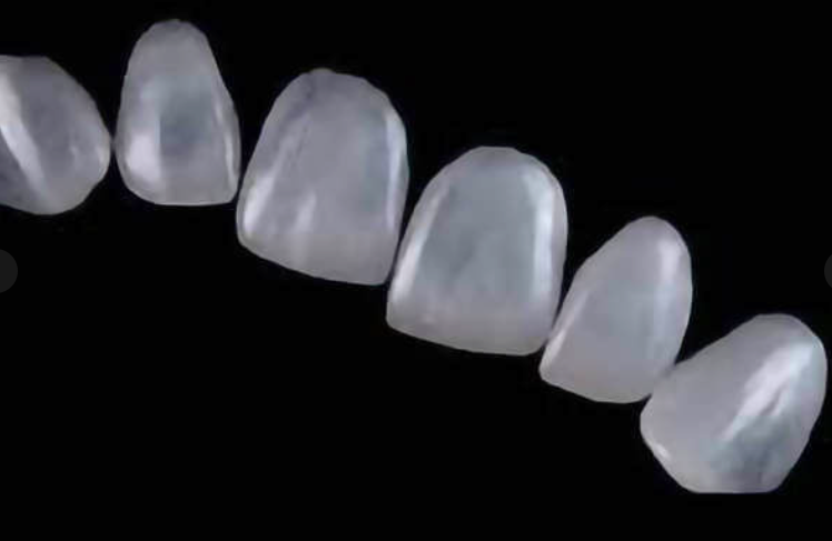 The Art of Feldspathic Veneers